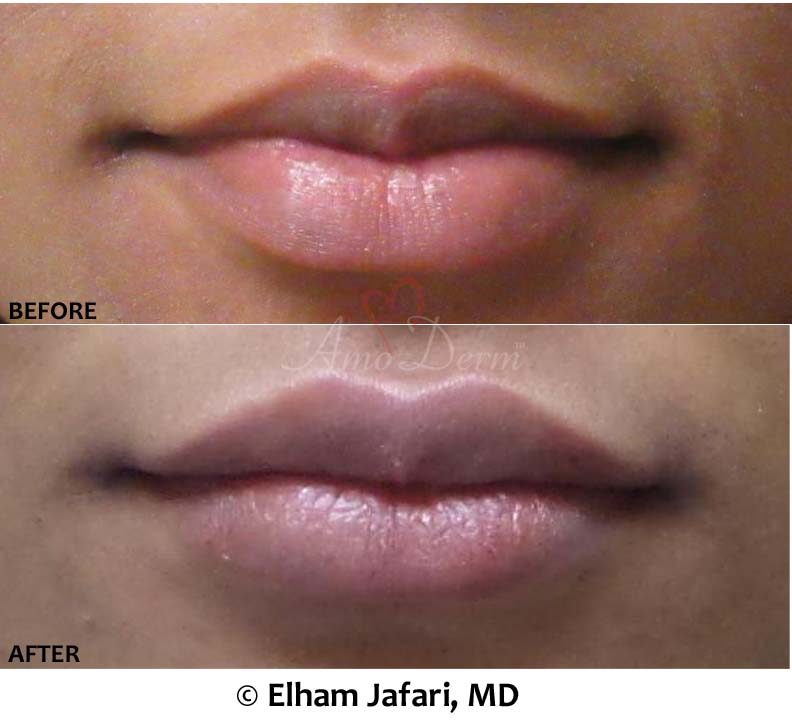 Lip Augmentation