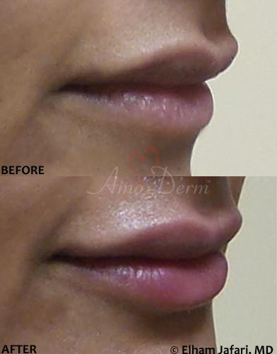 Lip Augmentation