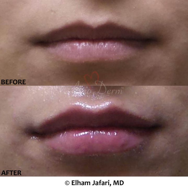 Lip Augmentation
