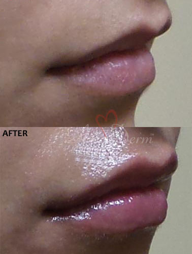 Lip Augmentation