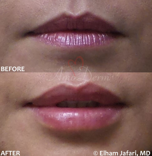 Lip Augmentation