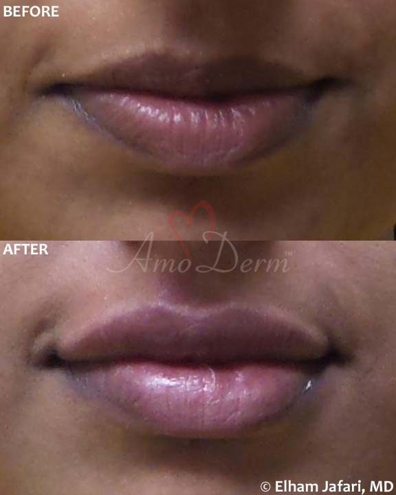 Lip Augmentation