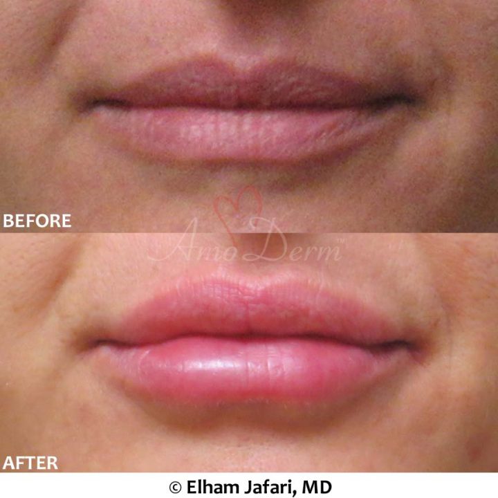 Lip Augmentation
