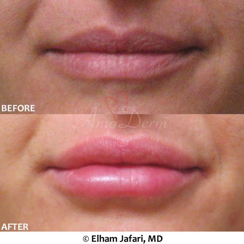 Lip Augmentation