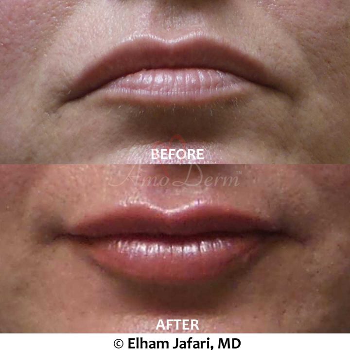 Lip Augmentation