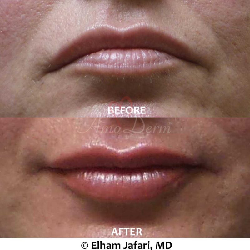 Lip Augmentation