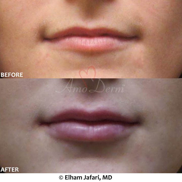 Lip Augmentation
