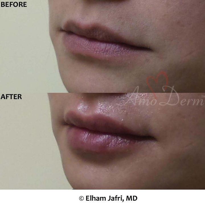Lip Augmentation