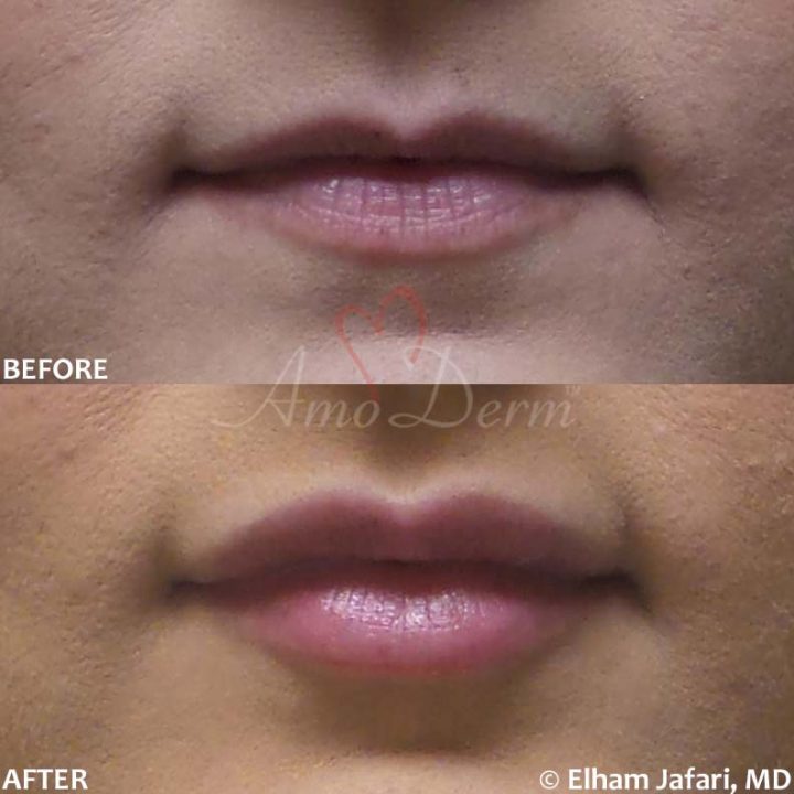 Lip Augmentation