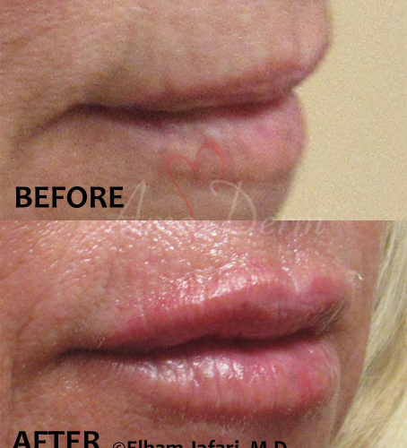 Lip Injection