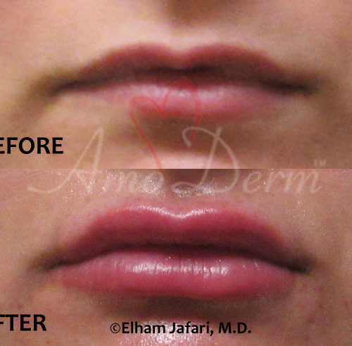Lip Injection - before and after picture with real result at Amoderm IRVINE, Orange County