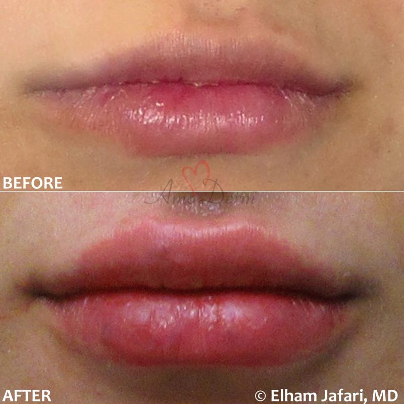 Lip Augmentation