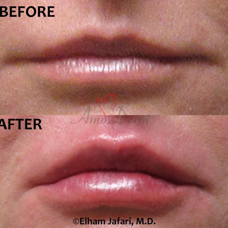 Lip Augmentation