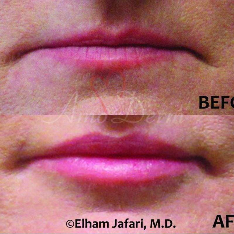 Lip Augmentation