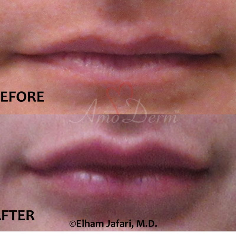 Lip Augmentation