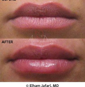 Lip Augmentation
