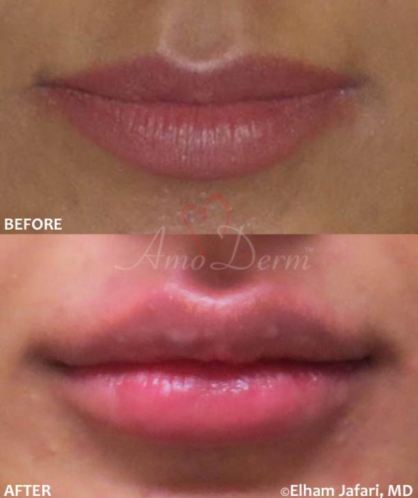 Lip Augmentation