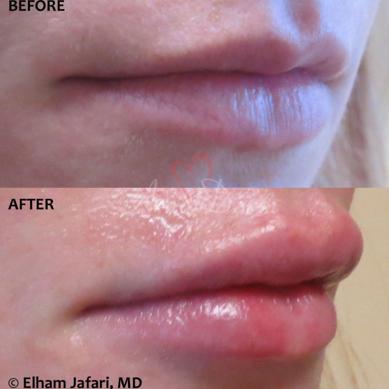 Lip Augmentation