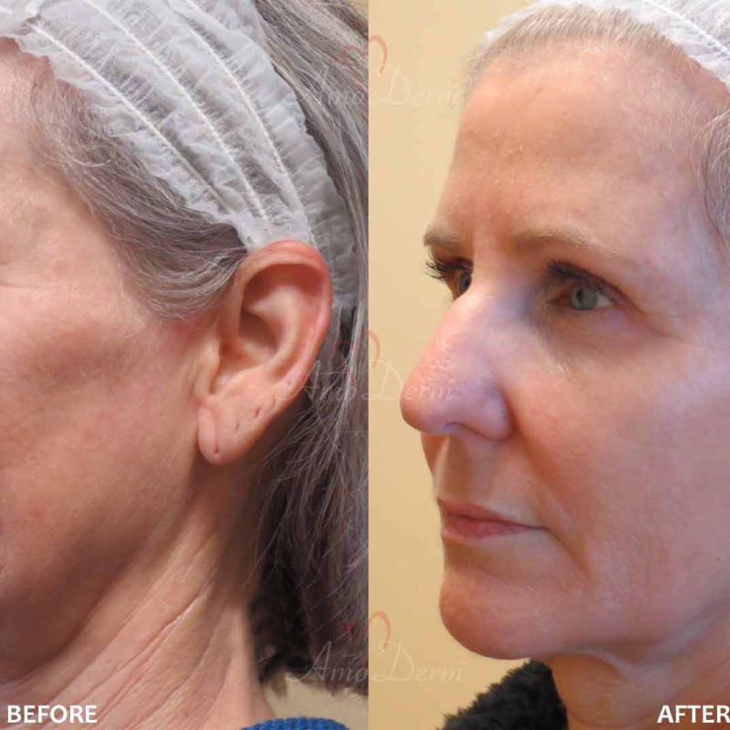 Liquid Facelift