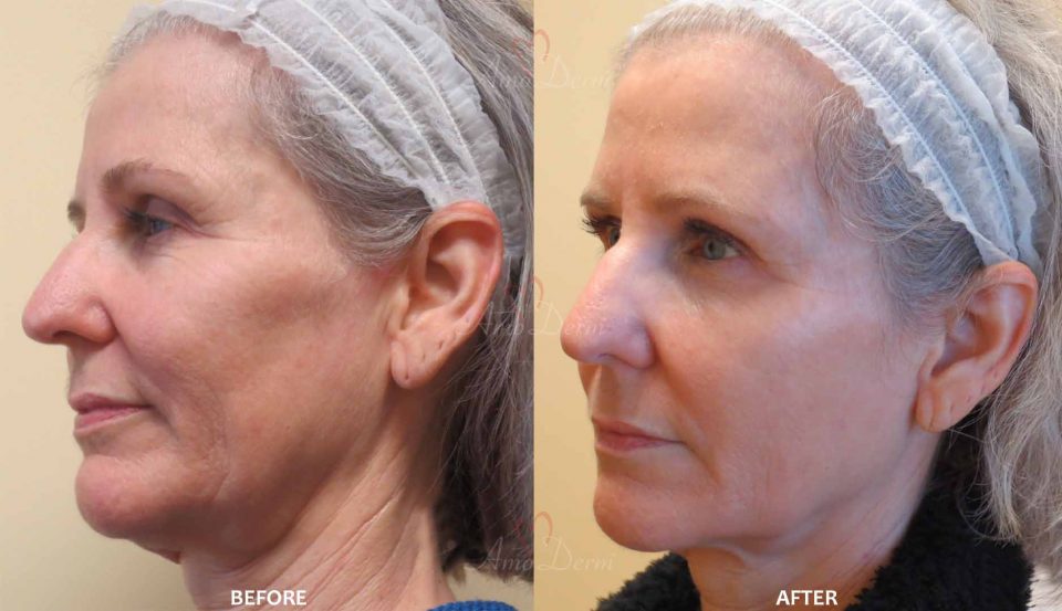 Liquid Facelift