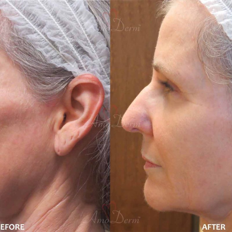 Liquid Facelift