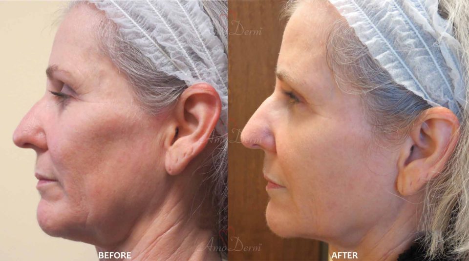 Liquid Facelift