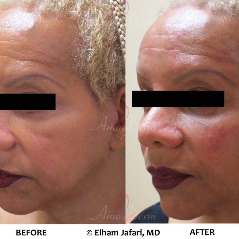 Liquid Facelift