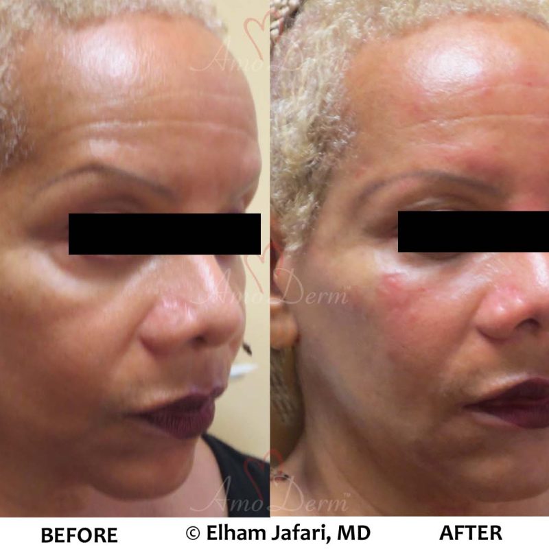 Liquid Facelift
