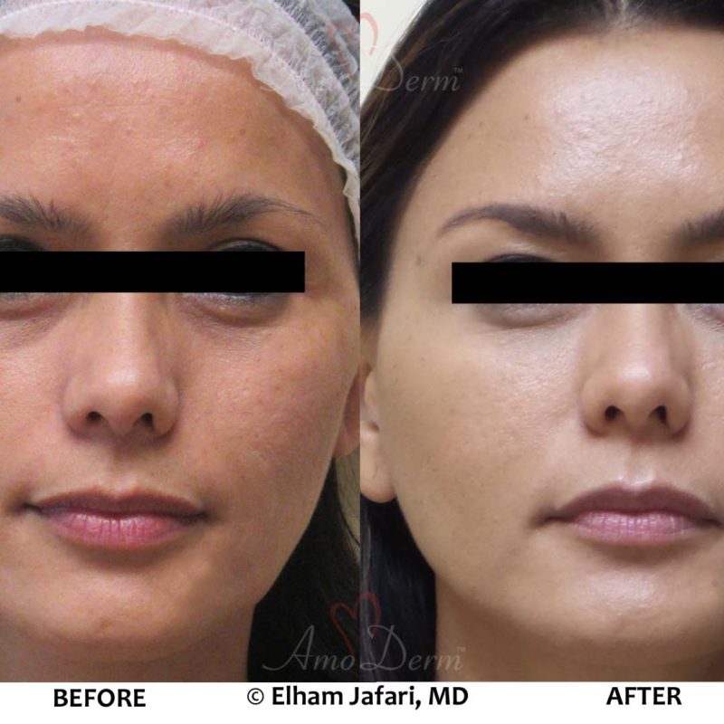 Liquid Facelift