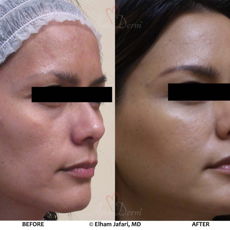 Liquid Facelift