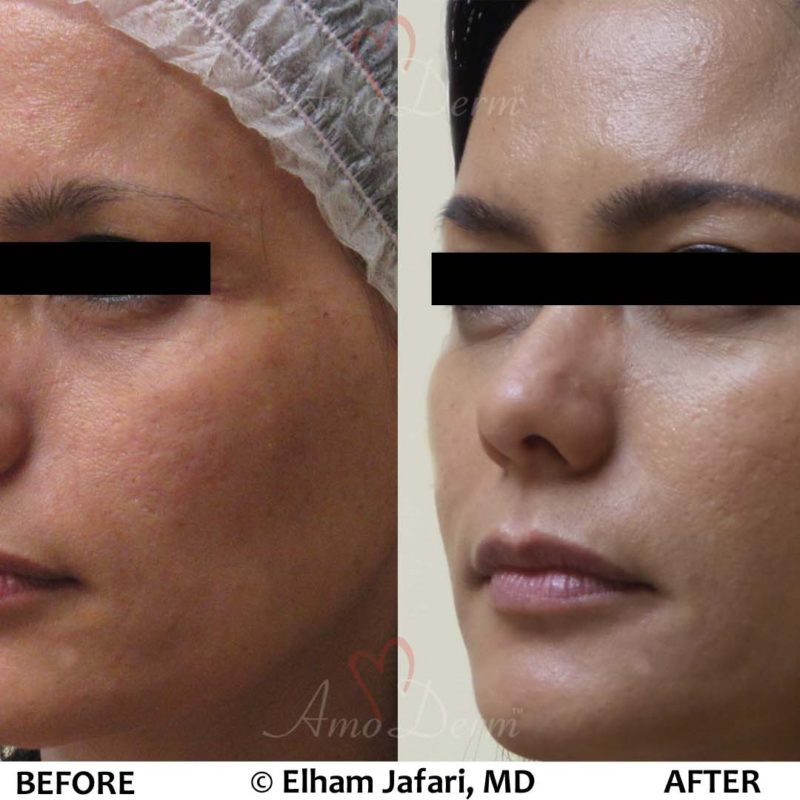 Liquid Facelift