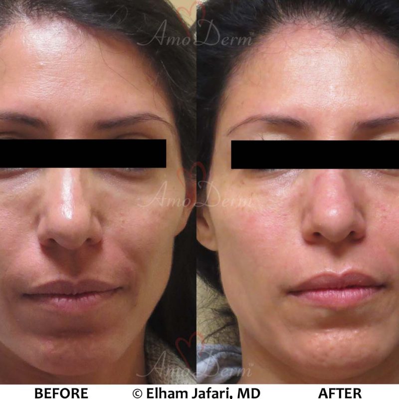 Liquid Facelift