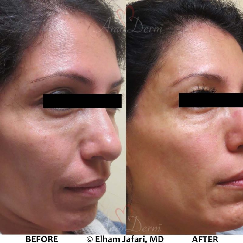 Liquid Facelift