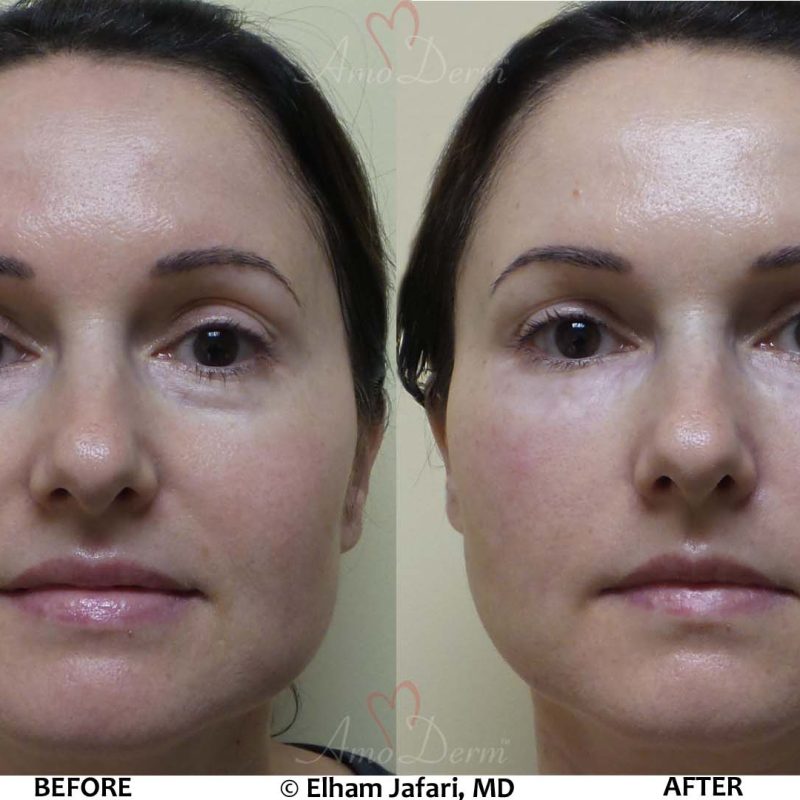 Liquid Facelift