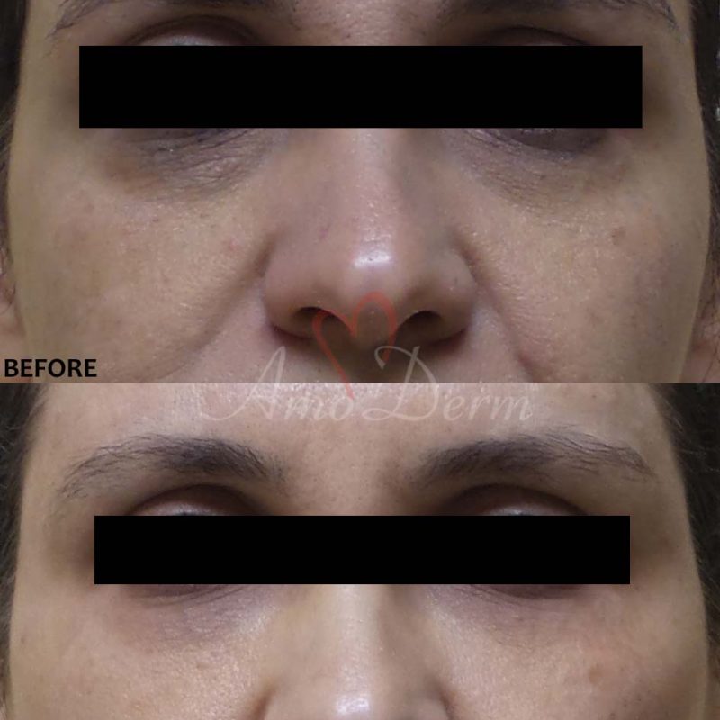 Liquid Facelift