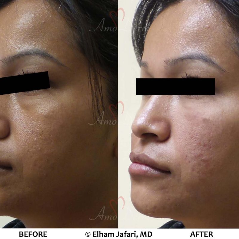 Liquid Facelift