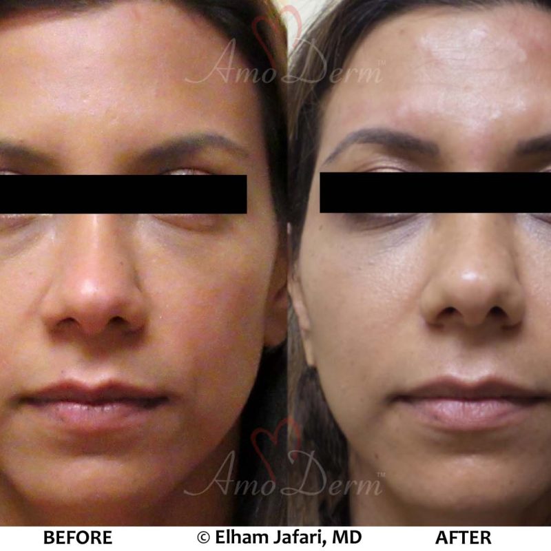 Liquid Facelift