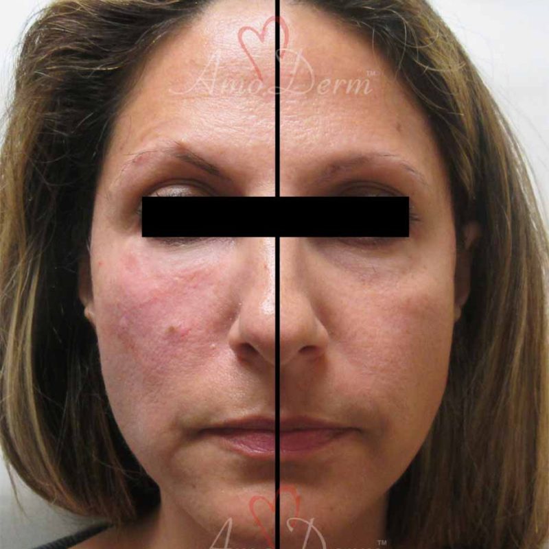 Liquid Facelift