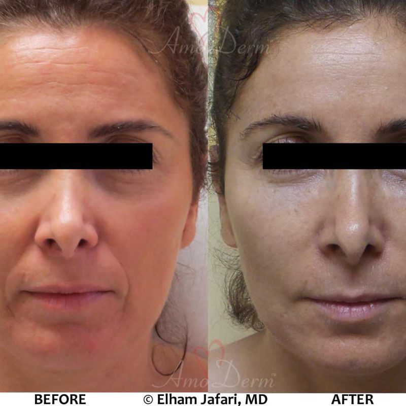 Liquid Facelift