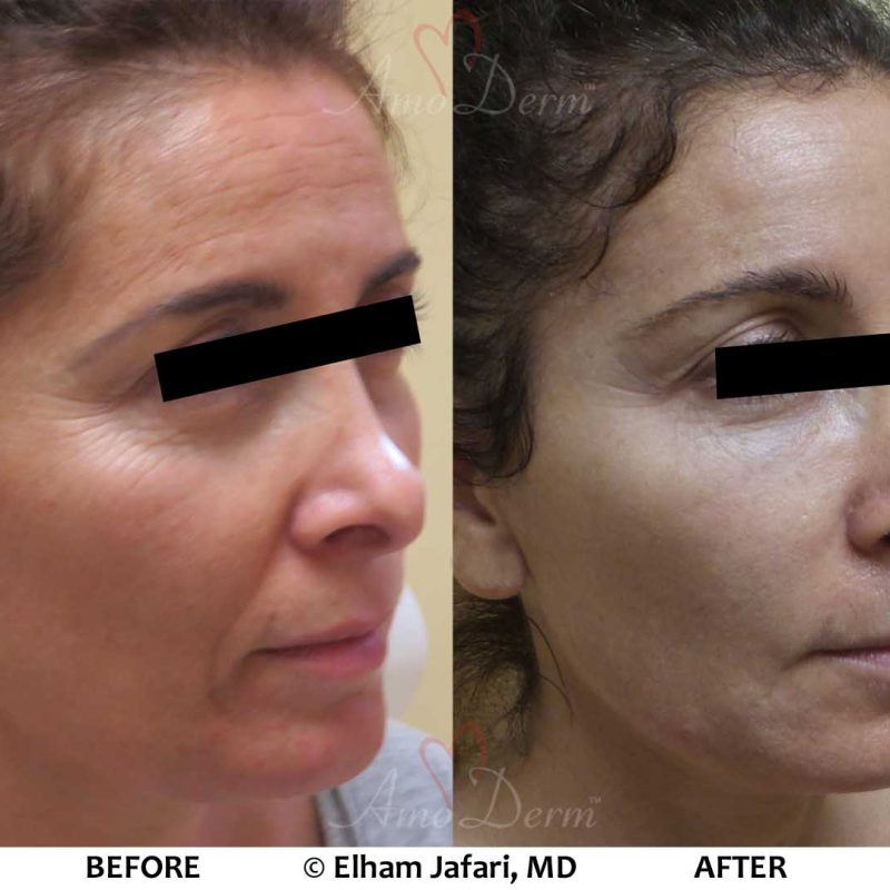 Liquid Facelift