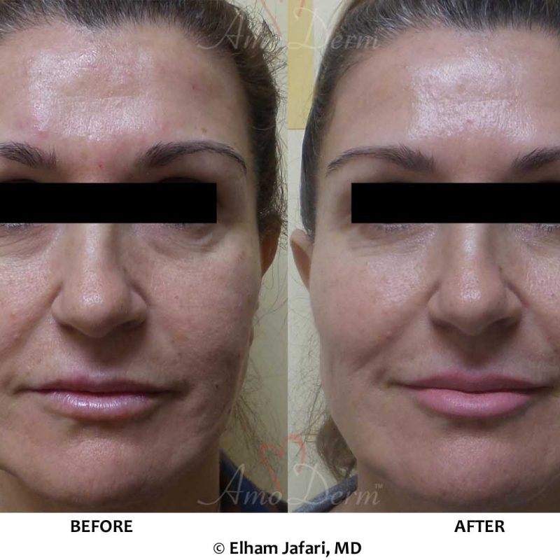 Liquid Facelift