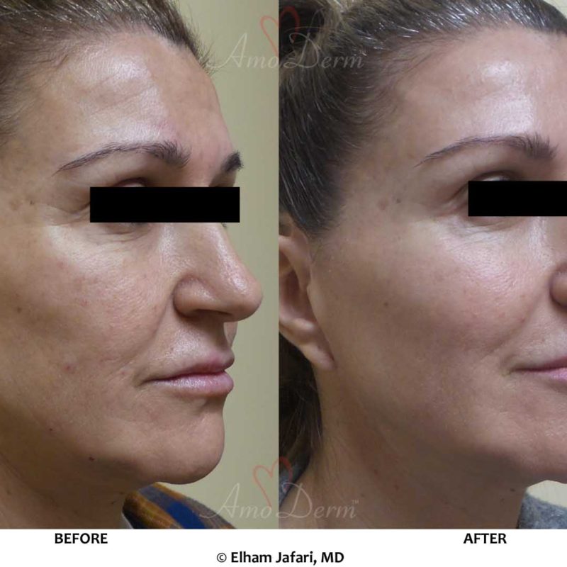 Liquid Facelift
