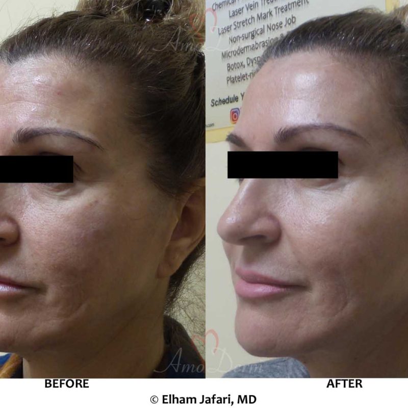 Liquid Facelift