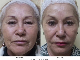 Liquid Facelift - Before &amp; After Gallery Real Results at Amoderm