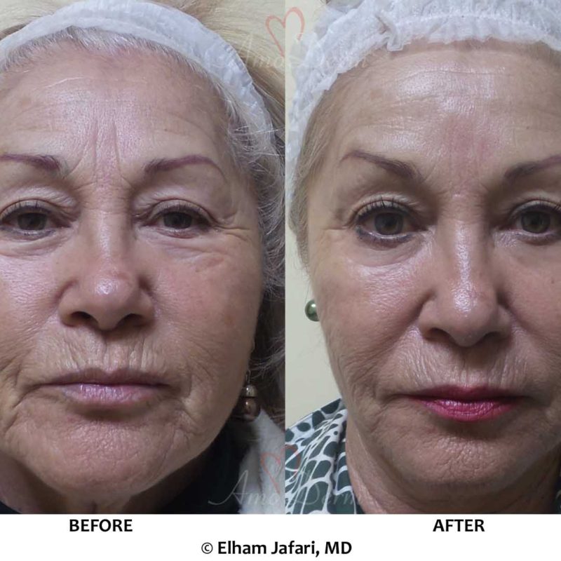 Liquid Facelift - Before &amp; After Gallery Real Results at Amoderm