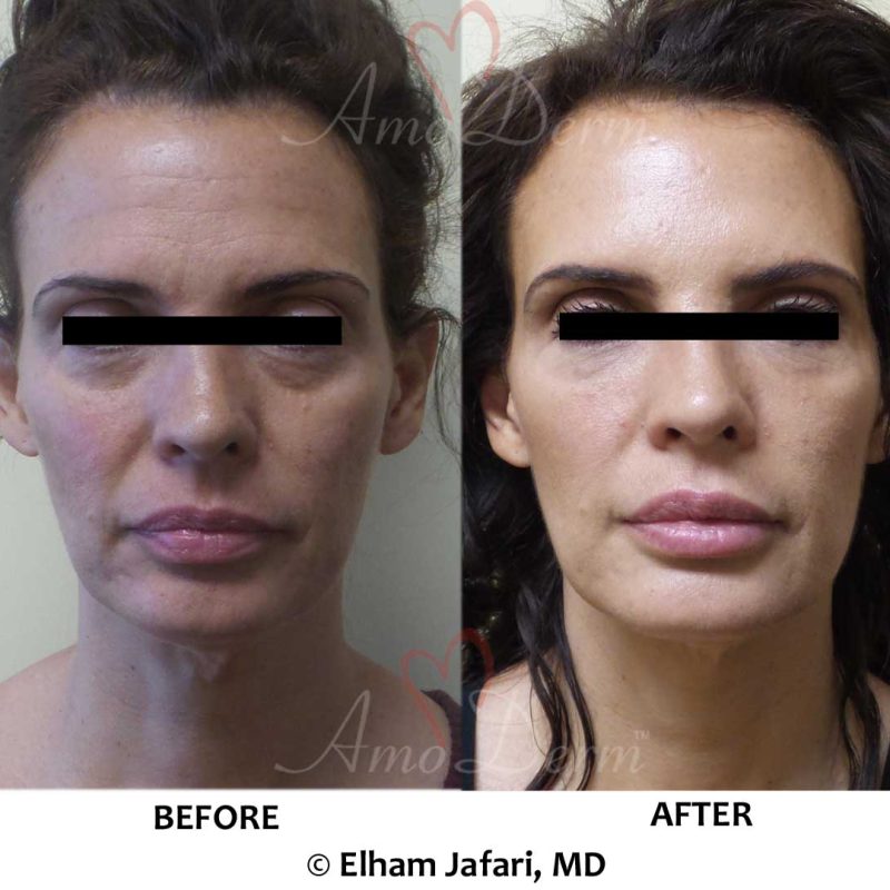 Liquid Facelift with Botox (or Dysport or Xeomin) in forehead and filler injection in cheeks and under eyes