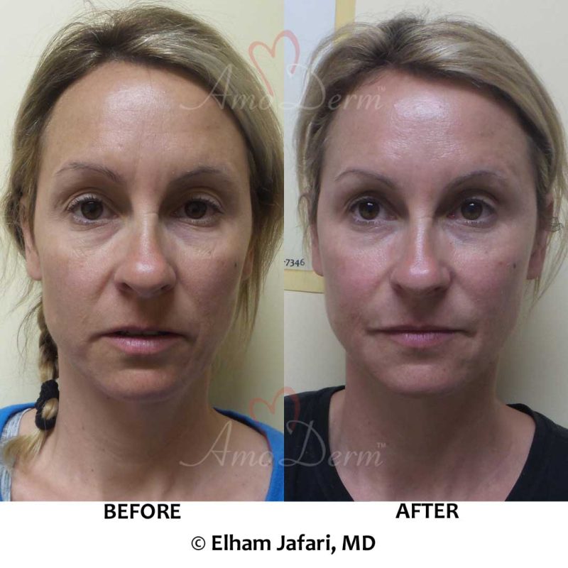 Liquid Facelift