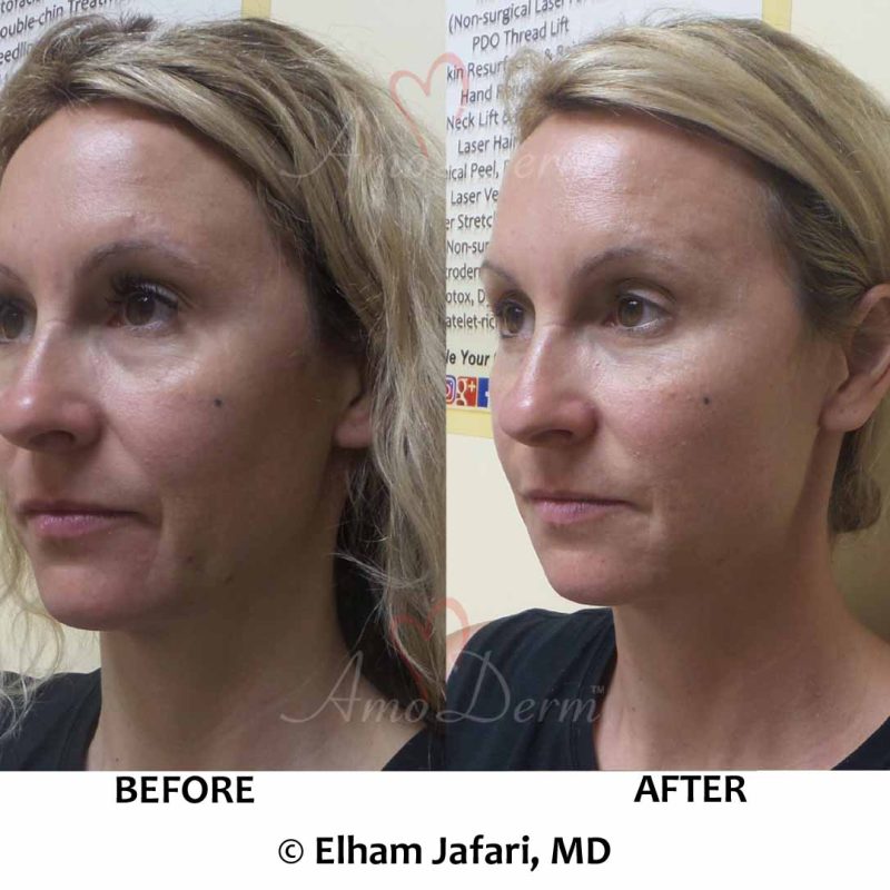 Liquid Facelift