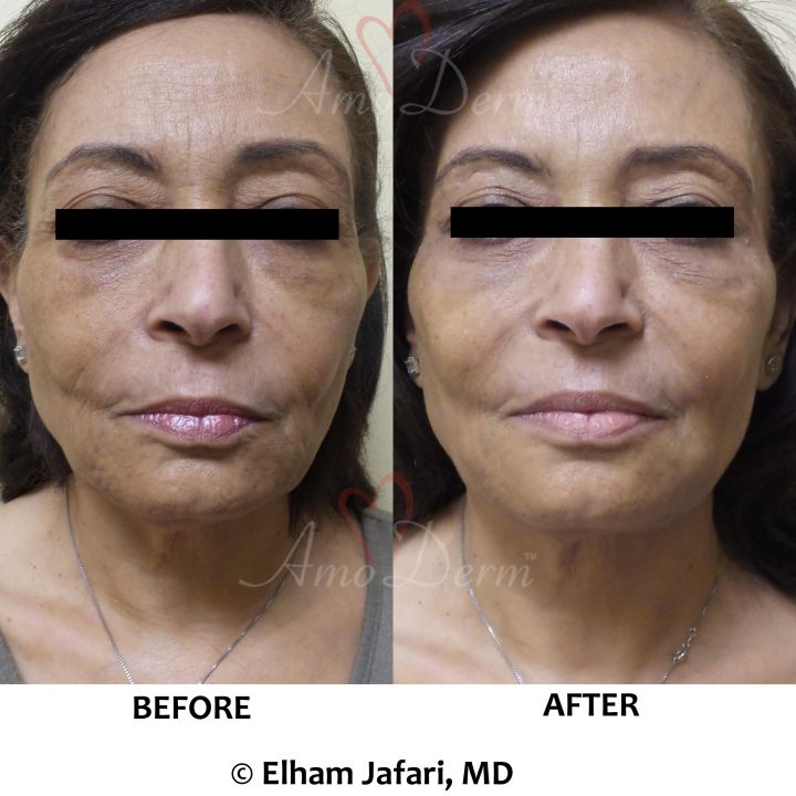 Liquid Facelift in forehead, crow's feet & frown lines & filler in cheeks, nasolabial folds & marionette lines