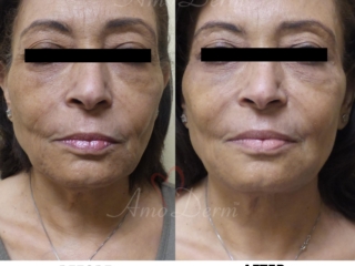 Liquid Facelift in forehead, crow's feet &amp; frown lines &amp; filler in cheeks, nasolabial folds &amp; marionette lines